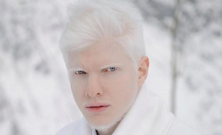 альбинизм